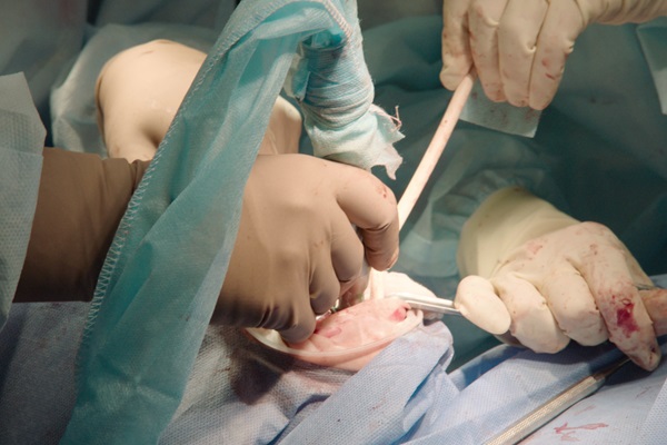 Oral Surgery: Recovering From A Tooth Extraction